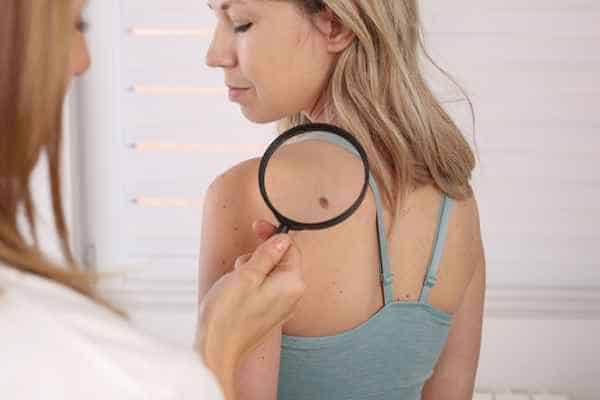 What Are Traditional Skin Lesion Removal Methods Cheltenham?