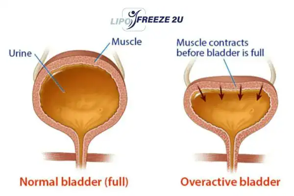 diagram of overactive bladder treatment Cheltenham