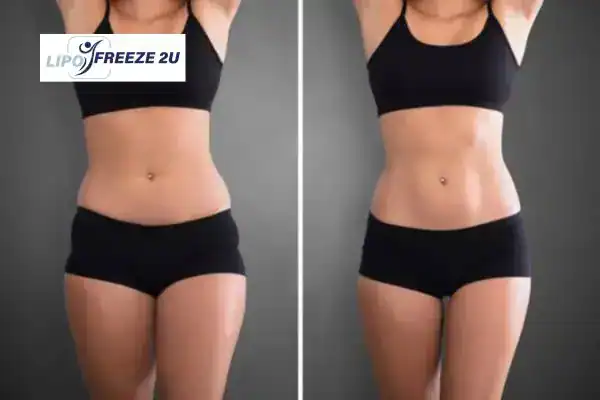 How Can LIPO FREEZE 2U Support Your Post-Pregnancy Body Recovery Cheltenham?