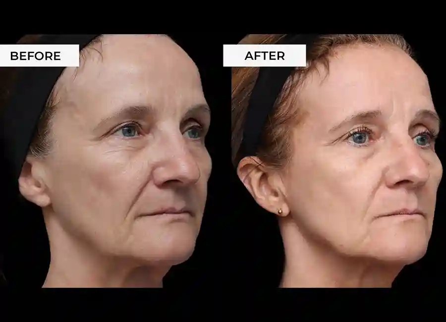 How Many RF Microneedling Sessions Will You Need to See a Difference Cheltenham?