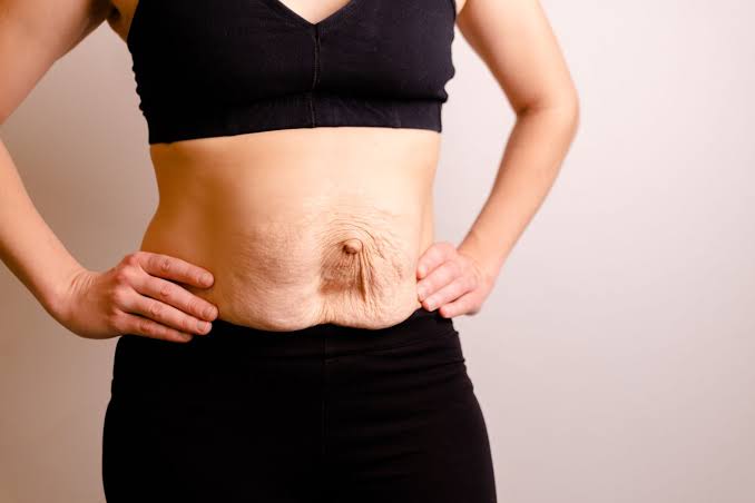 Is Surgery Really the Only Way to Repair Diastasis Recti Cheltenham?