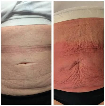 How Does RF Microneedling Improve Crepey, Thin and Uneven Skin Texture Cheltenham?