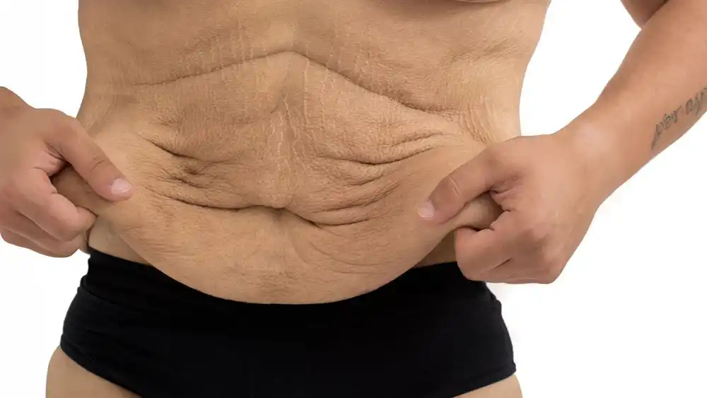 Why Does Weight Loss Medication Leave Some People With Loose or Sagging Skin Cheltenham?